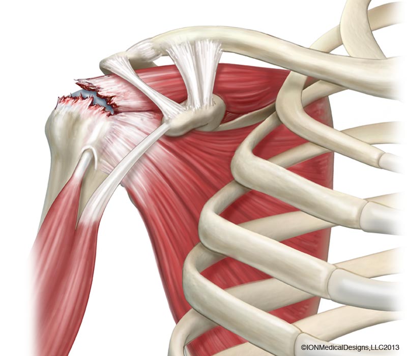 Full-Thickness vs. Partial-Thickness Tear of the Rotator Cuff