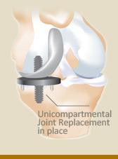 arthritis-unicompartmental - Joint Preservation Center